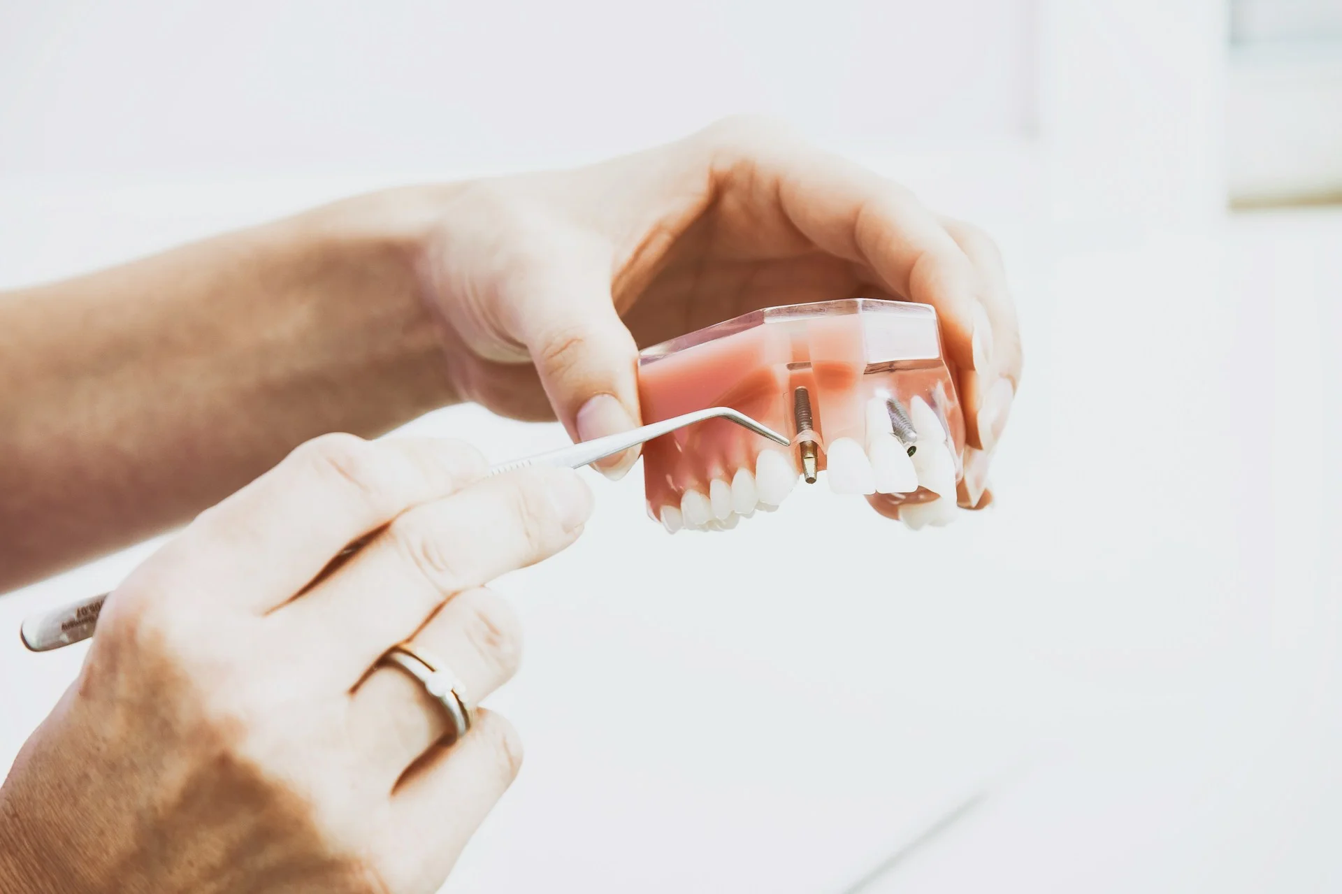 How Much Do Dental Implants Cost & How Long Do They Last? 2025 Guide picture